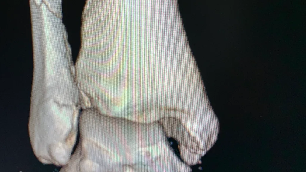 Mr Pal. Ramesh consultant foot & ankle specialist